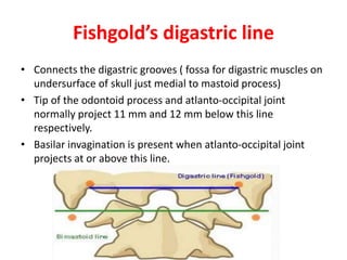 Fishgold’s digastric line
• Connects the digastric grooves ( fossa for digastric muscles on
undersurface of skull just medial to mastoid process)
• Tip of the odontoid process and atlanto-occipital joint
normally project 11 mm and 12 mm below this line
respectively.
• Basilar invagination is present when atlanto-occipital joint
projects at or above this line.
 