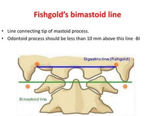 Fishgold’s bimastoid line
• Line connecting tip of mastoid process.
• Odontoid process should be less than 10 mm above this line -BI
 