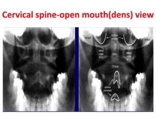 Cervical spine-open mouth(dens) view
 
