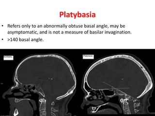 Platybasia
• Refers only to an abnormally obtuse basal angle, may be
asymptomatic, and is not a measure of basilar invagination.
• >140 basal angle.
 