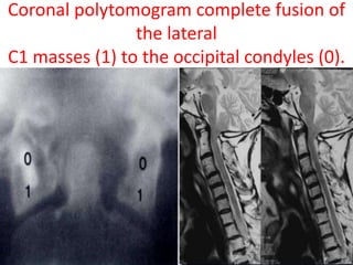 Coronal polytomogram complete fusion of
the lateral
C1 masses (1) to the occipital condyles (0).
 
