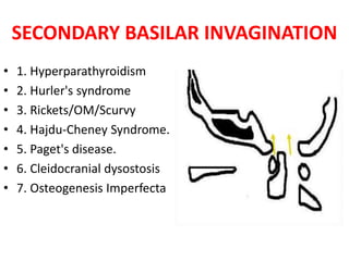 SECONDARY BASILAR INVAGINATION
• 1. Hyperparathyroidism
• 2. Hurler's syndrome
• 3. Rickets/OM/Scurvy
• 4. Hajdu-Cheney Syndrome.
• 5. Paget's disease.
• 6. Cleidocranial dysostosis
• 7. Osteogenesis Imperfecta
 