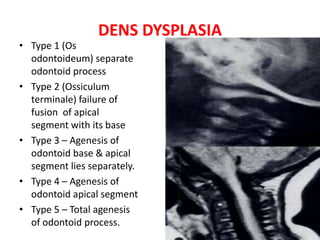 DENS DYSPLASIA
• Type 1 (Os
odontoideum) separate
odontoid process
• Type 2 (Ossiculum
terminale) failure of
fusion of apical
segment with its base
• Type 3 – Agenesis of
odontoid base & apical
segment lies separately.
• Type 4 – Agenesis of
odontoid apical segment
• Type 5 – Total agenesis
of odontoid process.
 