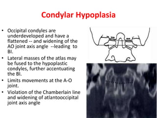 Condylar Hypoplasia
• Occipital condyles are
underdeveloped and have a
flattened -- and widening of the
AO joint axis angle --leading to
BI.
• Lateral masses of the atlas may
be fused to the hypoplastic
condyles, further accentuating
the BI.
• Limits movements at the A-O
joint.
• Violation of the Chamberlain line
and widening of atlantooccipital
joint axis angle
 