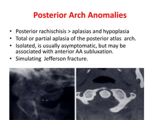 Posterior Arch Anomalies
• Posterior rachischisis > aplasias and hypoplasia
• Total or partial aplasia of the posterior atlas arch.
• Isolated, is usually asymptomatic, but may be
associated with anterior AA subluxation.
• Simulating Jefferson fracture.
 