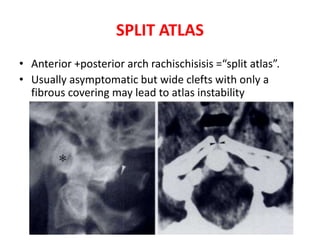 SPLIT ATLAS
• Anterior +posterior arch rachischisisis =“split atlas”.
• Usually asymptomatic but wide clefts with only a
fibrous covering may lead to atlas instability
 