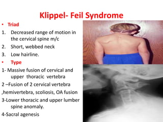 Klippel- Feil Syndrome
• Triad
1. Decreased range of motion in
the cervical spine m/c
2. Short, webbed neck
3. Low hairline.
• Type
1- Massive fusion of cervical and
upper thoracic vertebra
2 –Fusion of 2 cervical vertebra
,hemivertebra, scoliosis, OA fusion
3-Lower thoracic and upper lumber
spine anomaly.
4-Sacral agenesis
 