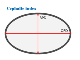Cephalic Index 91 Example Cranoficial anomalies and craniosynostosis | PPT
