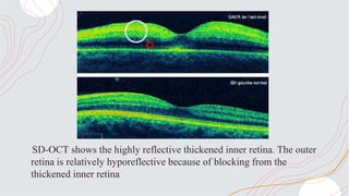 SD-OCT shows the highly reflective thickened inner retina. The outer
retina is relatively hyporeflective because of blocking from the
thickened inner retina
 