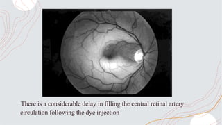 There is a considerable delay in filling the central retinal artery
circulation following the dye injection
 