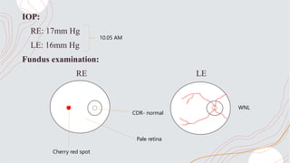 IOP:
RE: 17mm Hg
LE: 16mm Hg
Fundus examination:
RE LE
10.05 AM
WNL
CDR- normal
Pale retina
Cherry red spot
 