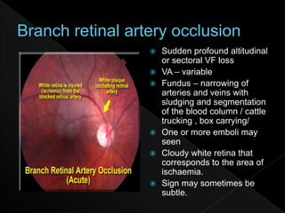  Sudden profound altitudinal
or sectoral VF loss
 VA – variable
 Fundus – narrowing of
arteries and veins with
sludging and segmentation
of the blood column / cattle
trucking , box carrying/
 One or more emboli may
seen
 Cloudy white retina that
corresponds to the area of
ischaemia.
 Sign may sometimes be
subtle.
 