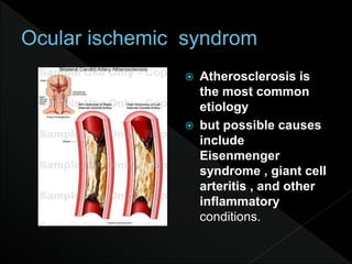  Atherosclerosis is
the most common
etiology
 but possible causes
include
Eisenmenger
syndrome , giant cell
arteritis , and other
inflammatory
conditions.
 
