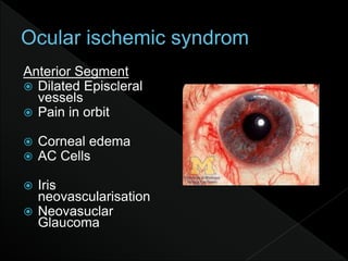 Anterior Segment
 Dilated Episcleral
vessels
 Pain in orbit
 Corneal edema
 AC Cells
 Iris
neovascularisation
 Neovasuclar
Glaucoma
 