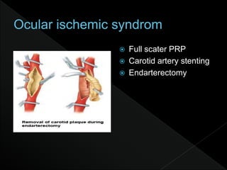  Full scater PRP
 Carotid artery stenting
 Endarterectomy
 