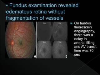  On fundus
fluorescein
angiography,
there was a
delay in
arterial filling
and AV transit
time was 70
sec
 