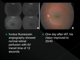  fundus fluorescein
angiography showed
normal retinal
perfusion with AV
transit time of 12
seconds
 One day after IAT, his
vision improved to
20/40
 