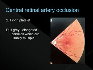 2. Fibrin platelet
Dull grey , elongated
particles which are
usually multiple
 