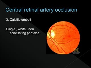 3. Calcific emboli
Single , white , non
scintillating particles
 