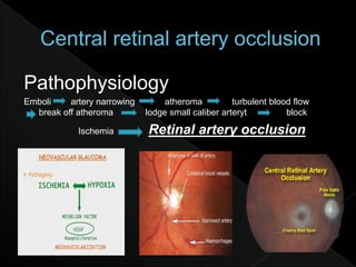 Pathophysiology
Emboli artery narrowing atheroma turbulent blood flow
break off atheroma lodge small caliber arteryt block
Ischemia Retinal artery occlusion
 