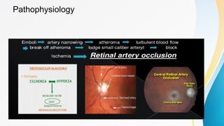 Central retinal artery occlusion , a medical emergency | PPTX