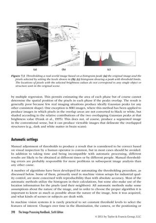 (a) (b) (c) 
Figure 7.3 Thresholding a real-world image based on a histogram peak: (a) the original image and the 
pixels selected by setting the levels shown in (b); (c) histogram showing a peak with threshold limits. 
The locations of pixels with the selected brightness values do not correspond to any single object or 
structure unit in the original scene. 
by multiple regression. This permits estimating the area of each phase but of course cannot 
determine the spatial position of the pixels in each phase if the peaks overlap. The result is 
generally poor because few real imaging situations produce ideally Gaussian peaks (or any 
other consistent shape). One exception is MRI images, where this method has been applied to 
produce images in which pixels in the overlap areas are not converted to black or white, but 
shaded according to the relative contributions of the two overlapping Gaussian peaks at that 
brightness value (Frank et al., 1995). This does not, of course, produce a segmented image 
in the conventional sense, but it can produce viewable images that delineate the overlapped 
structures (e.g., dark and white matter in brain scans). 
Automatic settings 
Manual adjustment of thresholds to produce a result that is considered to be correct based 
on visual inspection by a human operator is common, but in most cases should be avoided. 
In addition to taking time and being incompatible with automatic processing, different 
results are likely to be obtained at different times or by different people. Manual threshold-ing 
errors are probably responsible for more problems in subsequent image analysis than 
any other cause. 
A number of algorithms have been developed for automating the thresholding procedure, as 
discussed below. Some of them, primarily used in machine vision setups for industrial qual-ity 
control, are more concerned with reproducibility than with absolute accuracy. Most of the 
automatic methods utilize the histogram in their calculations, but some also make use of the 
location information for the pixels (and their neighbors). All automatic methods make some 
assumptions about the nature of the image, and in order to choose the proper algorithm it is 
important to know as much as possible about the nature of the image, how it was acquired, 
and what kinds of scenes or subjects are dealt with. 
In machine vision systems it is rarely practical to set constant threshold levels to select the 
features of interest. Changes over time in the illumination, the camera, or the positioning or 
398 The Image Processing Handbook, Sixth Edition 
© 2011 by Taylor  Francis Group, LLC 
 
