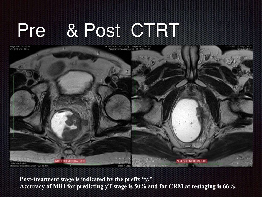 Ca Rectum Imaging