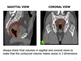 76
SAGITTAL VIEW CORONAL VIEW
Always check final volumes in sagittal and coronal views to
make that the contoured volume makes sense in 3 dimensions
 
