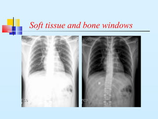 Soft tissue and bone windows
 
