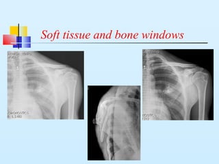 Soft tissue and bone windows
 