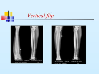 Vertical flip
MR.RAVINDER 33YRS, M 19/08/2004 14:20:08
RIGHT LEG, AP&LAT 268
MR.RAVINDER 33YRS, M 19/08/2004 14:20:08
RIGHT LEG, AP&LAT 268
 