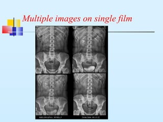 Multiple images on single film
MRS.SWAPNA 30YRS, F 29/06/2004 09:15:32
 