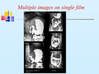 Multiple images on single film
MRS.FARIDA 30YRS ,F 12/8/2004
09:15:23
 