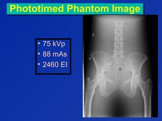 Phototimed Phantom ImagePhototimed Phantom Image
• 75 kVp
• 88 mAs
• 2460 EI
 