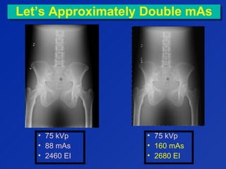 Let’s Approximately Double mAsLet’s Approximately Double mAs
• 75 kVp
• 88 mAs
• 2460 EI
• 75 kVp
• 160 mAs
• 2680 EI
 