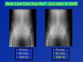 How Low Can You Go? Cut mAs in Half!How Low Can You Go? Cut mAs in Half!
• 75 kVp
• 88 mAs
• 2460 EI
• 75 kVp
• 40 mAs
• 2060 EI
 