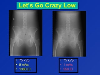 Let’s Go Crazy LowLet’s Go Crazy Low
• 75 kVp
• 8 mAs
• 1380 EI
• 75 kVp
• 1 mAs
• 550 EI
 