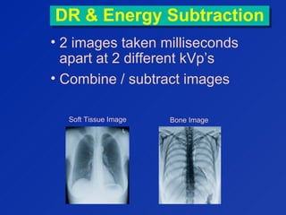 DR & Energy SubtractionDR & Energy Subtraction
• 2 images taken milliseconds
apart at 2 different kVp’s
• Combine / subtract images
Soft Tissue Image Bone Image
 
