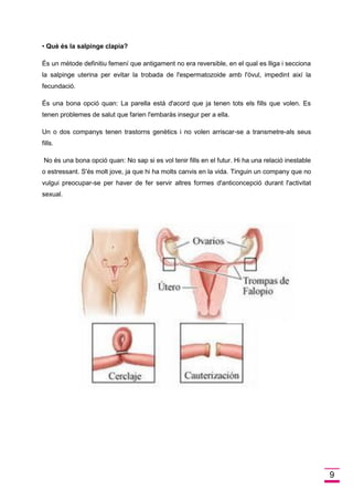 9 
• Què és la salpinge clapia? 
És un mètode definitiu femení que antigament no era reversible, en el qual es lliga i secciona la salpinge uterina per evitar la trobada de l'espermatozoide amb l'òvul, impedint així la fecundació. 
És una bona opció quan: La parella està d'acord que ja tenen tots els fills que volen. Es tenen problemes de salut que farien l'embaràs insegur per a ella. 
Un o dos companys tenen trastorns genètics i no volen arriscar-se a transmetre-als seus fills. 
No és una bona opció quan: No sap si es vol tenir fills en el futur. Hi ha una relació inestable o estressant. S'és molt jove, ja que hi ha molts canvis en la vida. Tinguin un company que no vulgui preocupar-se per haver de fer servir altres formes d'anticoncepció durant l'activitat sexual. 
 