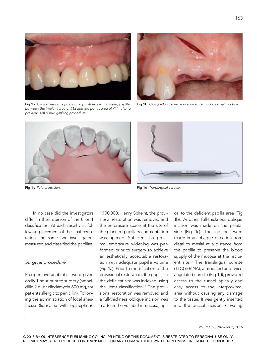 Creating papilla implant (dentalxp) by Stuart