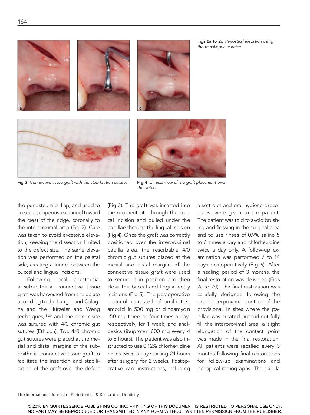 Creating papilla implant (dentalxp) by Stuart