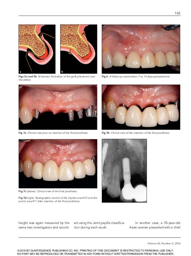 Creating papilla implant (dentalxp) by Stuart
