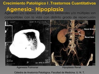 Agenesia y/o aplasia en órganos bilaterales y/o múltiples son compatibles con la vida con distinto grado de repercusión clínica. Cátedra de Anatomía Patológica. Facultad de Medicina. U. N. T. Crecimiento Patológico I .Trastornos Cuantitativos Agenesia Pulmonar Hipoplasia Renal 