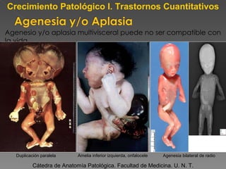Agenesio y/o aplasia multivisceral puede no ser compatible con la vida Cátedra de Anatomía Patológica. Facultad de Medicina. U. N. T. Crecimiento Patológico I. Trastornos Cuantitativos Amelia inferior izquierda, onfalocele  Duplicación paralela Agenesia bilateral de radio 