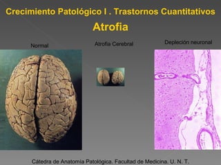 Cátedra de Anatomía Patológica. Facultad de Medicina. U. N. T. Crecimiento Patológico I . Trastornos Cuantitativos Normal Depleción neuronal Atrofia Cerebral Atrofia 