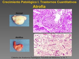 Crecimiento Patológico I. Trastornos Cuantitativos Cátedra de Anatomía Patológica. Facultad de Medicina. U. N. T. Normal Atrófico Atrofia 