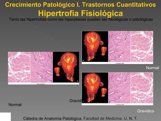 Crecimiento Patológico I. Trastornos Cuantitativos Tanto las hipertrofias como las hiperplasias pueden ser fisiológicas o patológicas  Gravidico Normal Normal Gravidico Cátedra de Anatomía Patológica.  Facultad de Medicina. U. N. T. Hipertrofia Fisiológica 