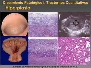 Cátedra de Anatomía Patológica. Facultad de Medicina. U. N. T. Crecimiento Patológico I. Trastornos Cuantitativos Normal 