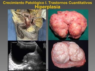 Hiperplasia Crecimiento Patológico I. Trastornos Cuantitativos Cátedra de Anatomía Patológica. Facultad de Medicina. U. N. T. 