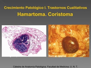 Crecimiento Patológico I. Trastornos Cualitativos Cátedra de Anatomía Patológica. Facultad de Medicina. U. N. T. Bazo en epiplon Cartílago en pulmón Hamartoma. Coristoma 